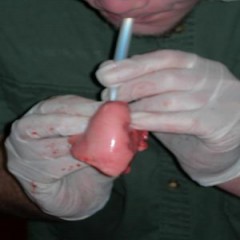 lung1